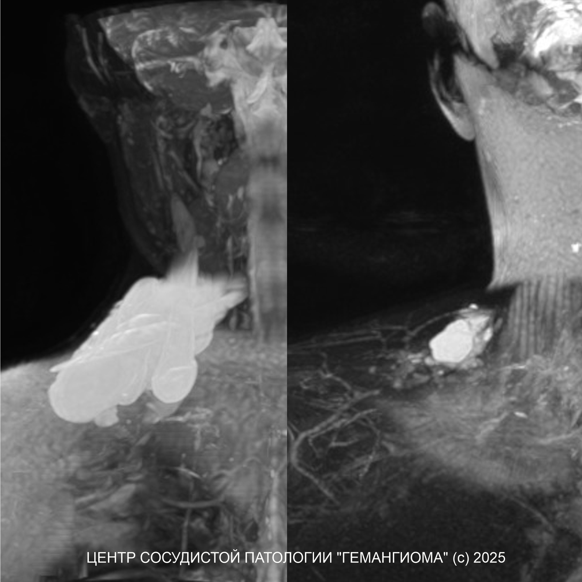 Лечение лимфатических мальформаций Гемоблок