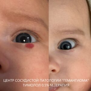 Лечение гемангиом тимололом
