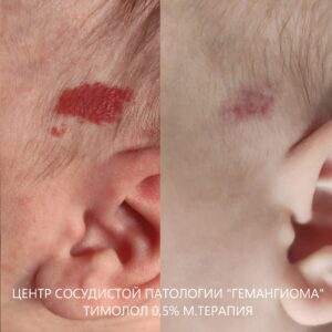 Лечение тимололом гемангиом