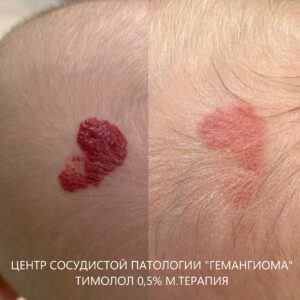 Лечение гемангиом тимололом