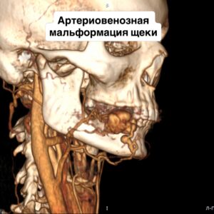 проведена уникальная операция пациентке с врожденной артериовенозной мальформацией в области щеки