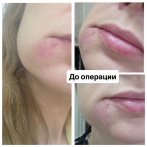 проведена уникальная операция пациентке с врожденной артериовенозной мальформацией в области щеки