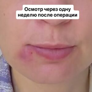 проведена уникальная операция пациентке с врожденной артериовенозной мальформацией в области щеки